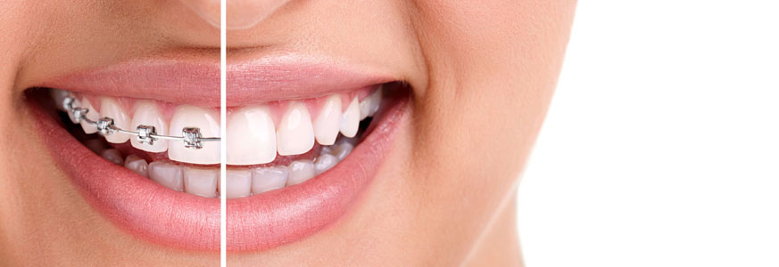 Orthodontique – InvisalignMD | Centre Dentaire Côte-de-Sable | Dentiste Ottawa
